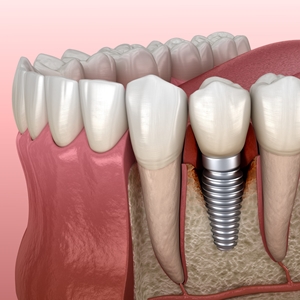 Implantologia Dentale Di Qualità Sesto San Giovanni