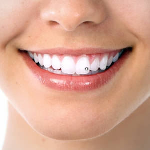 Brillantino dente Milano